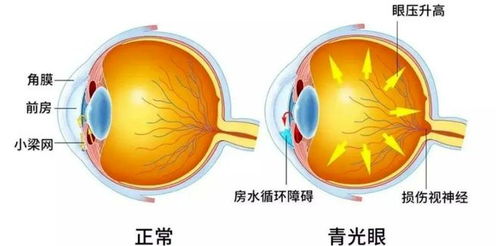 不可逆的 视力小偷 ,我们应该如何应对ta